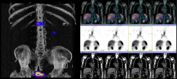 Medicina Nuclear a Manresa